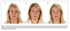 Vampire Facelift El Dorado Hills